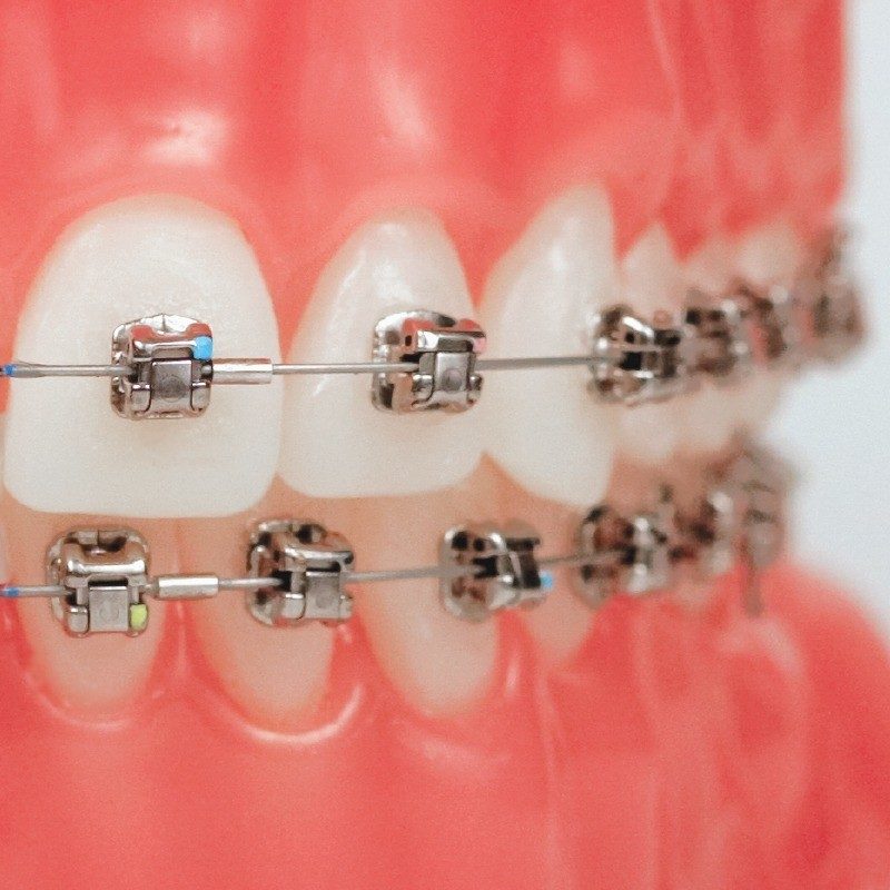 damon-braces damon-braces